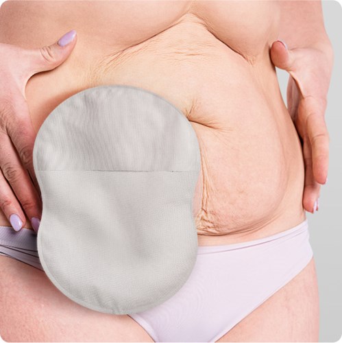 A closeup shot of a woman using an 8-shaped ostomy pouch with Leak Defense™.